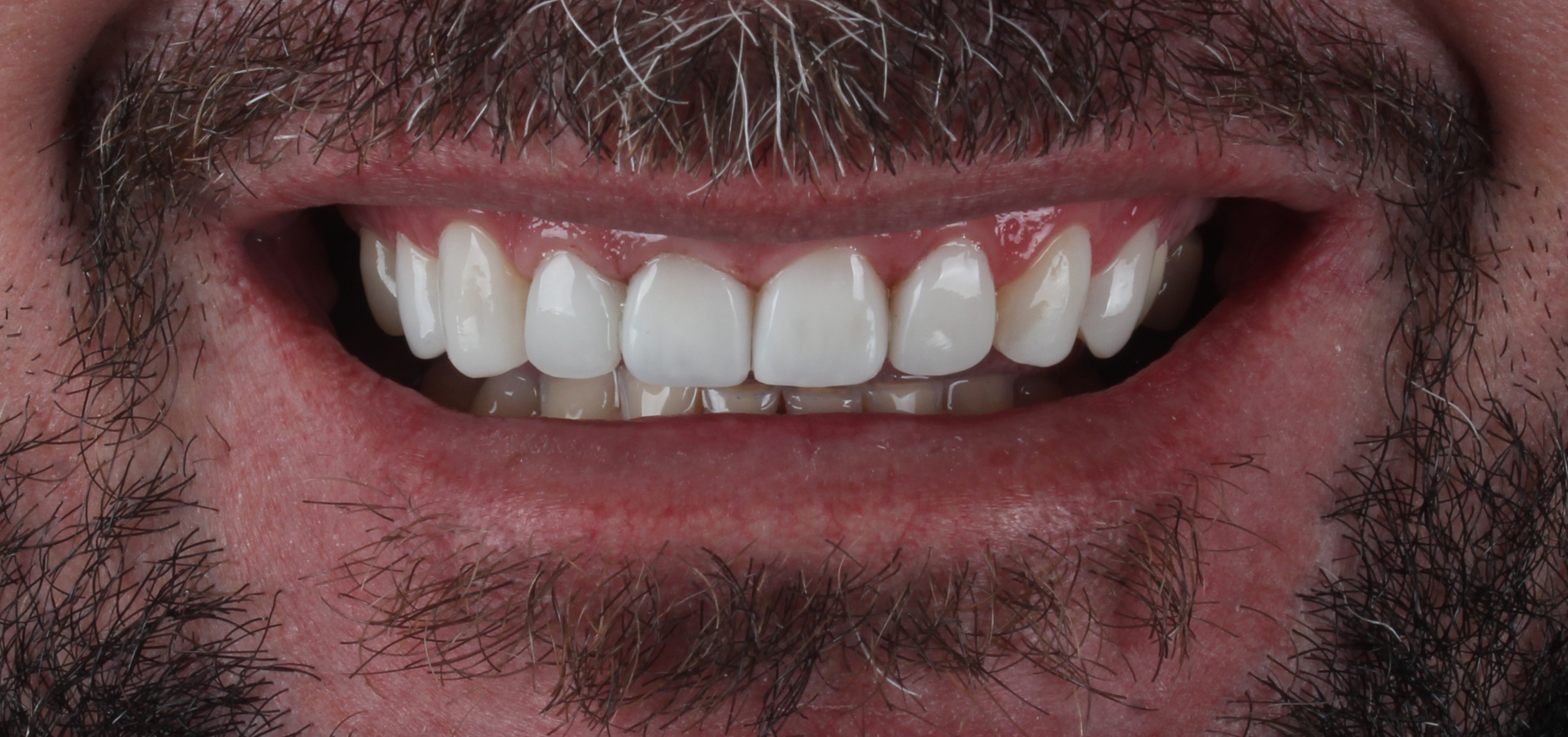 Depois das facetas de resina